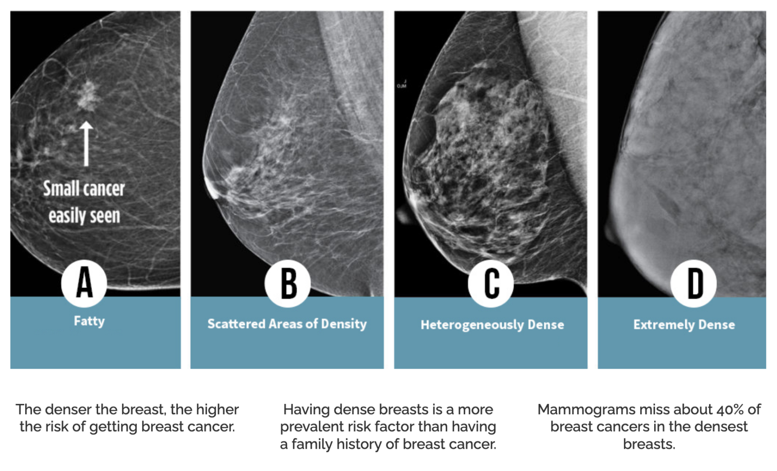 Breast Cancer Detection (Computer Vision)